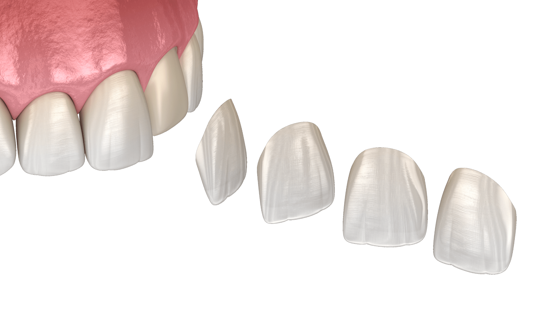 Встановлення вінірів