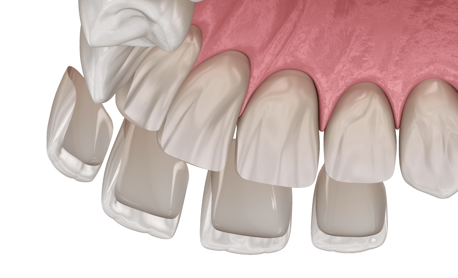 Встановлення вінірів