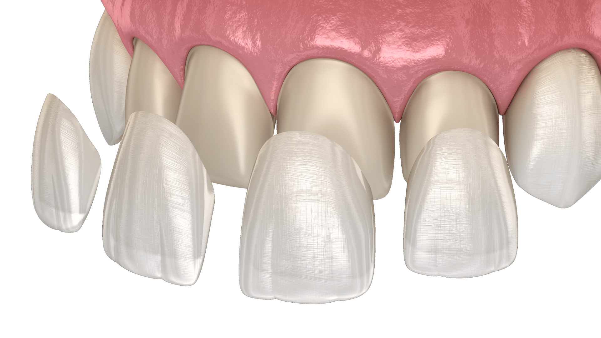 Встановлення вінірів