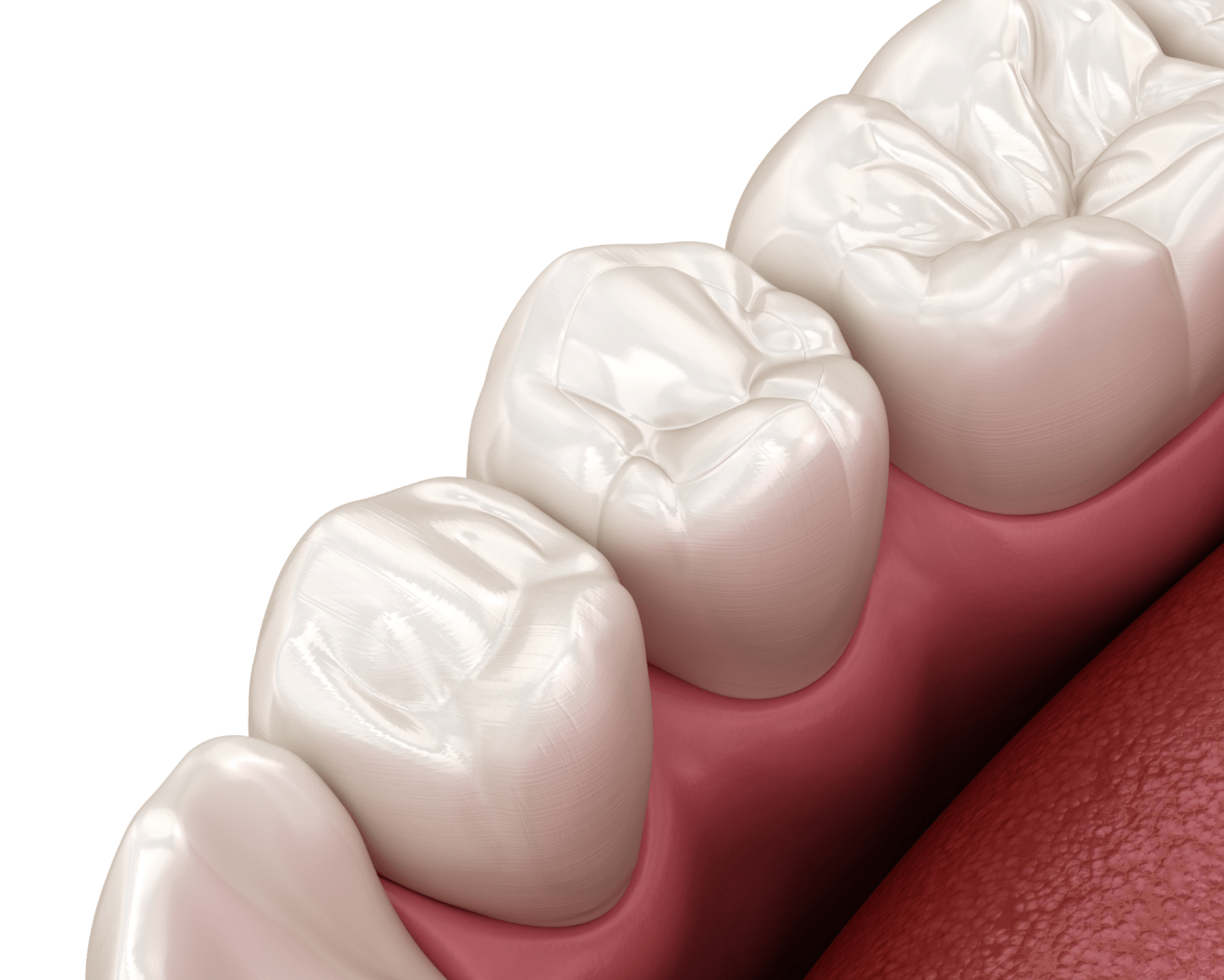 Підготовка зубів
