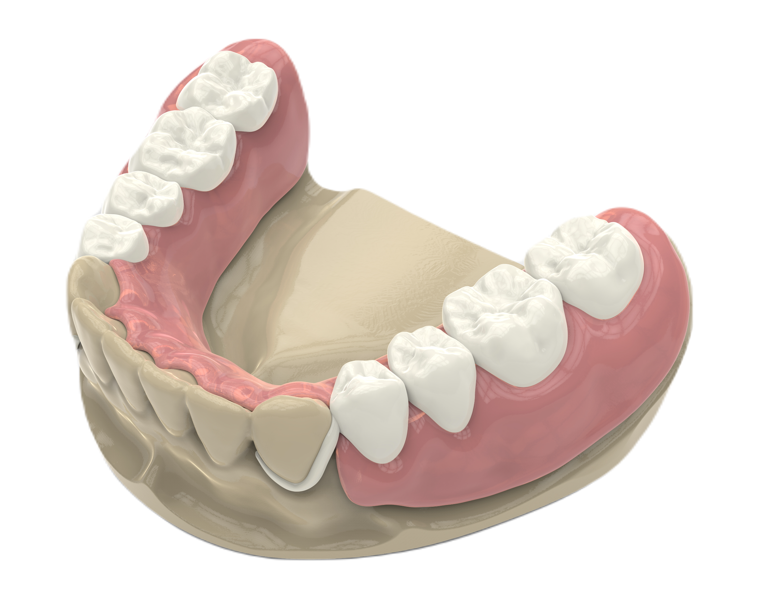 Примірка протезу