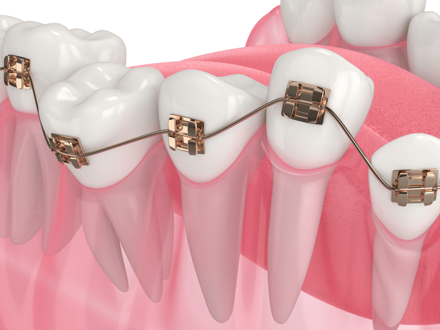 Безлігатурні брекети
