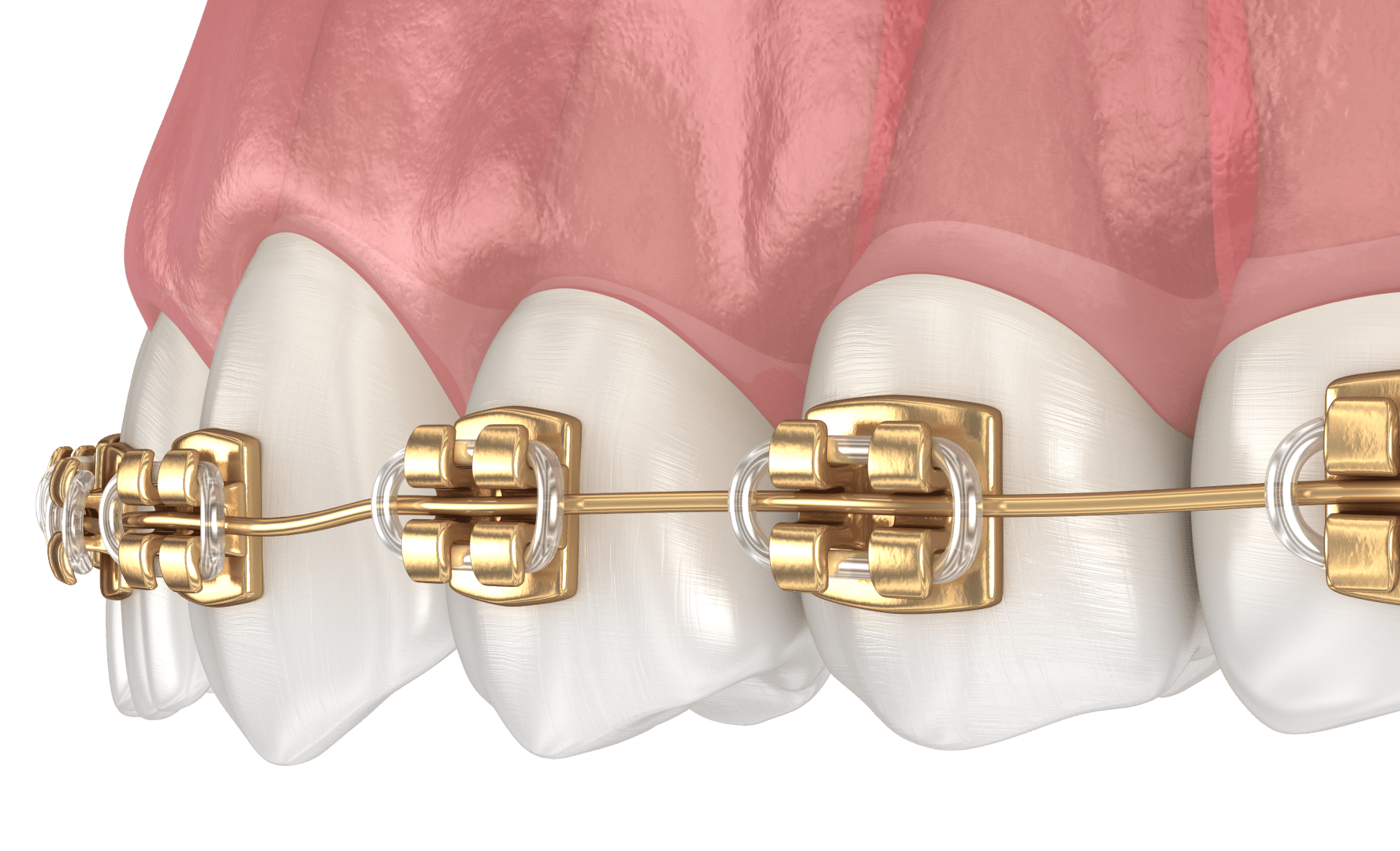 Лігатурні брекети