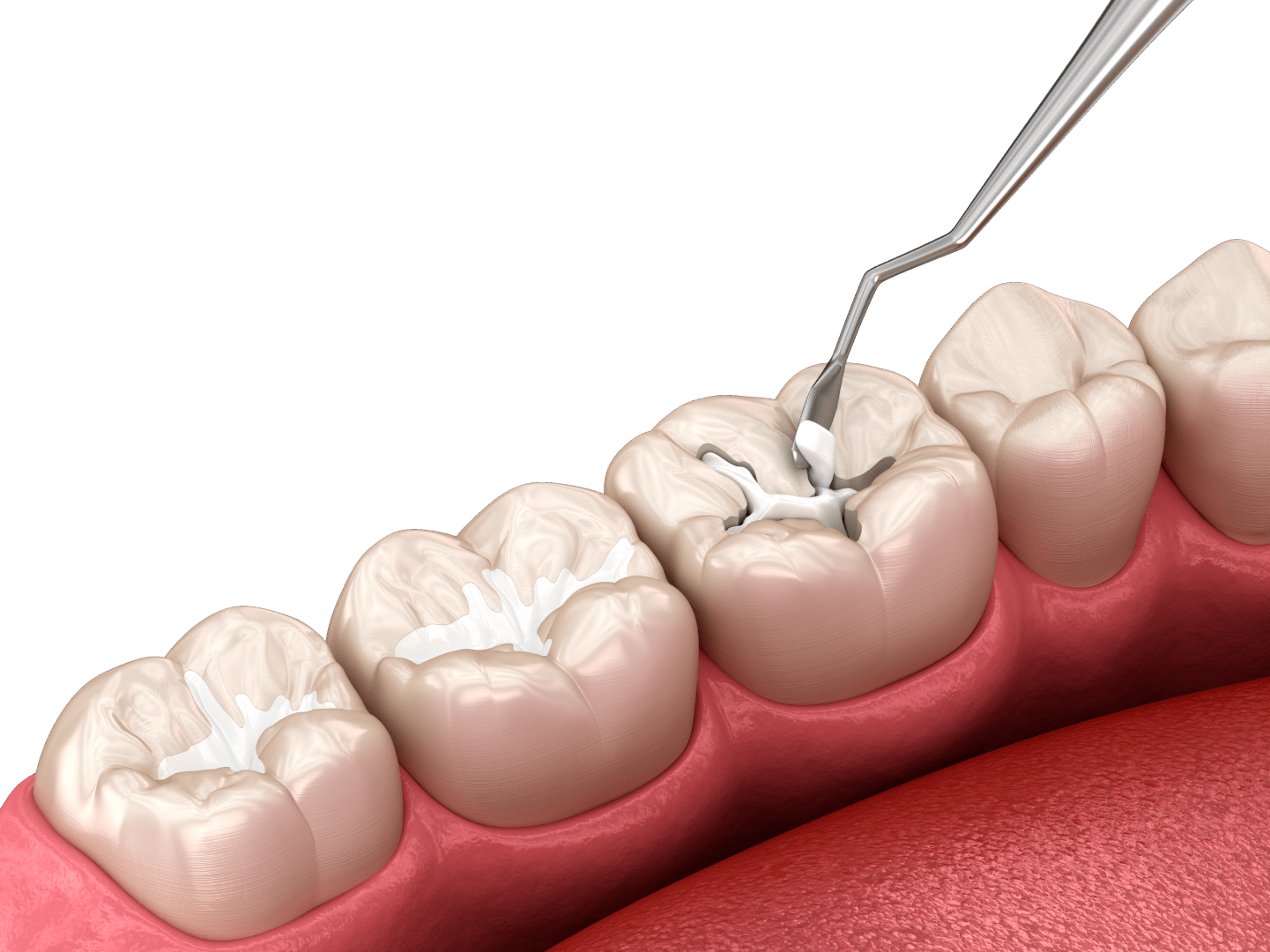 Лікування зубних хвороб