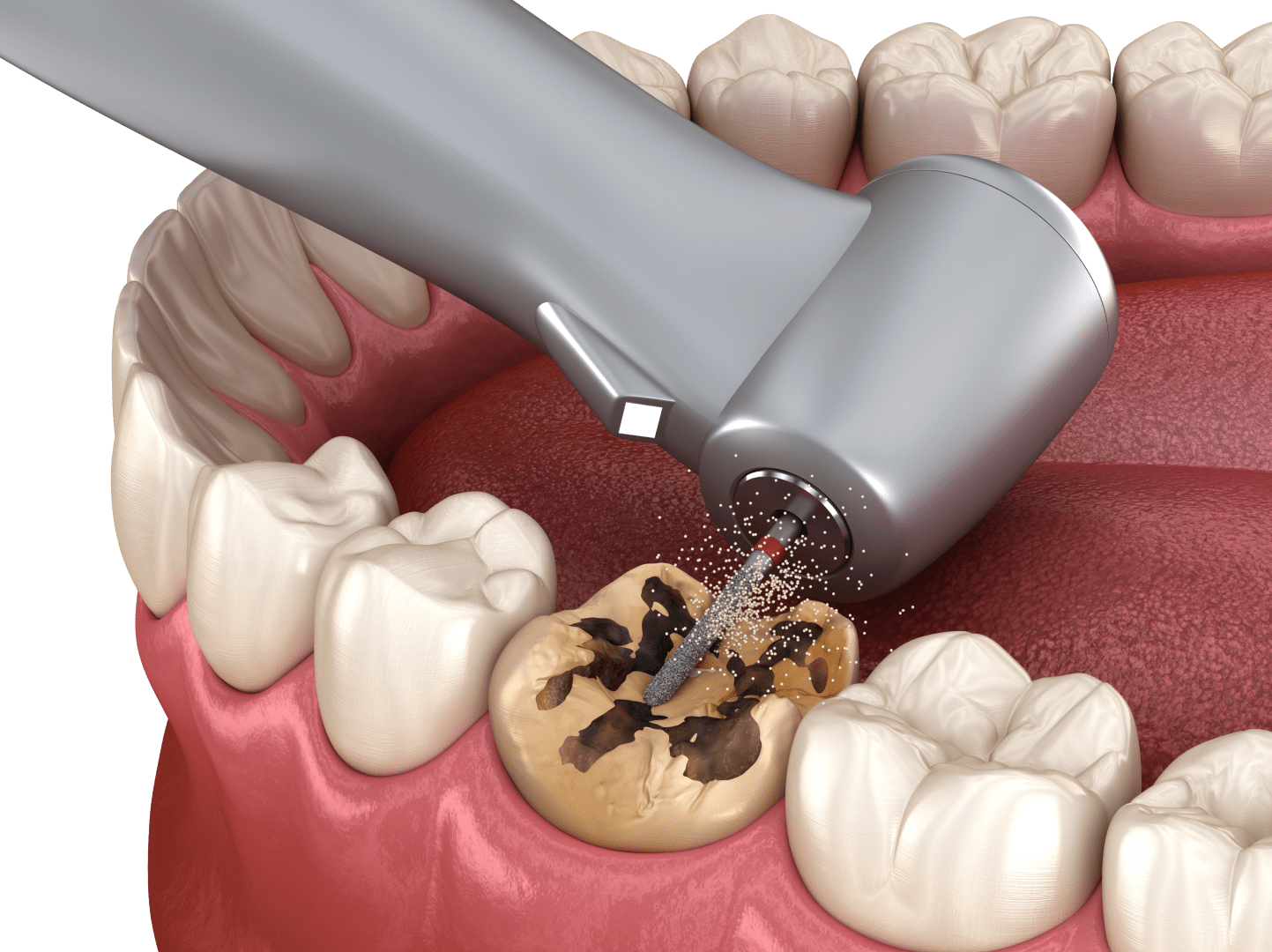 Підготовка зубів