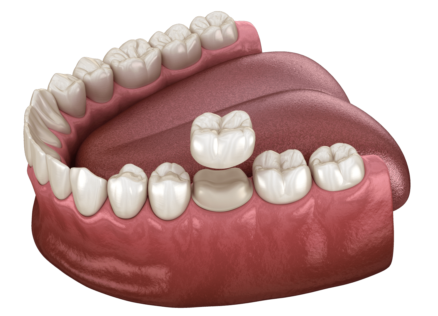 Коронки з кераміки