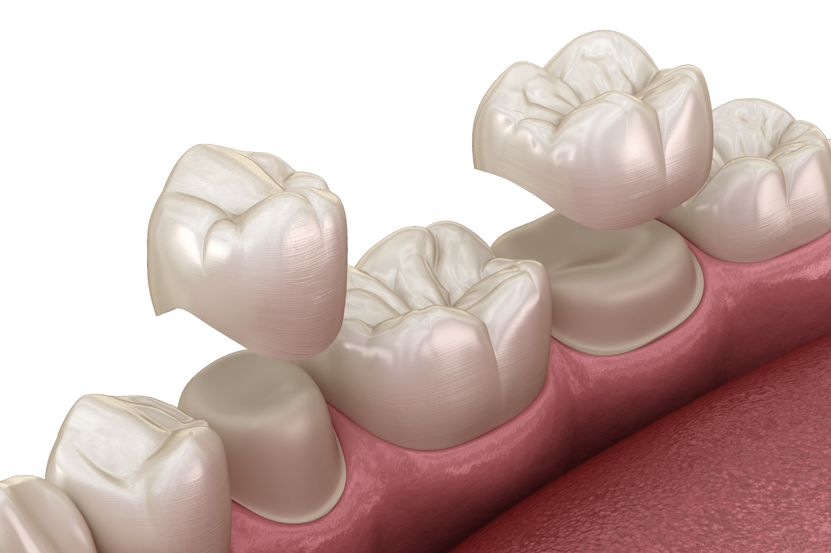 Встановлення коронки