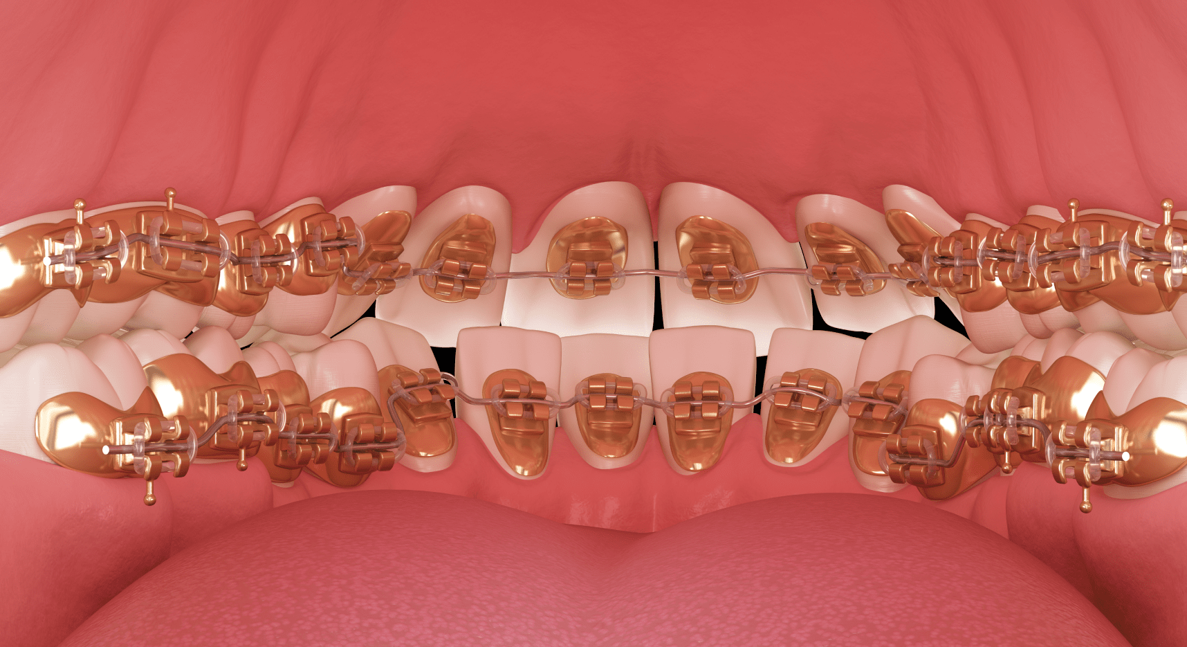 Лінгвальні брекети