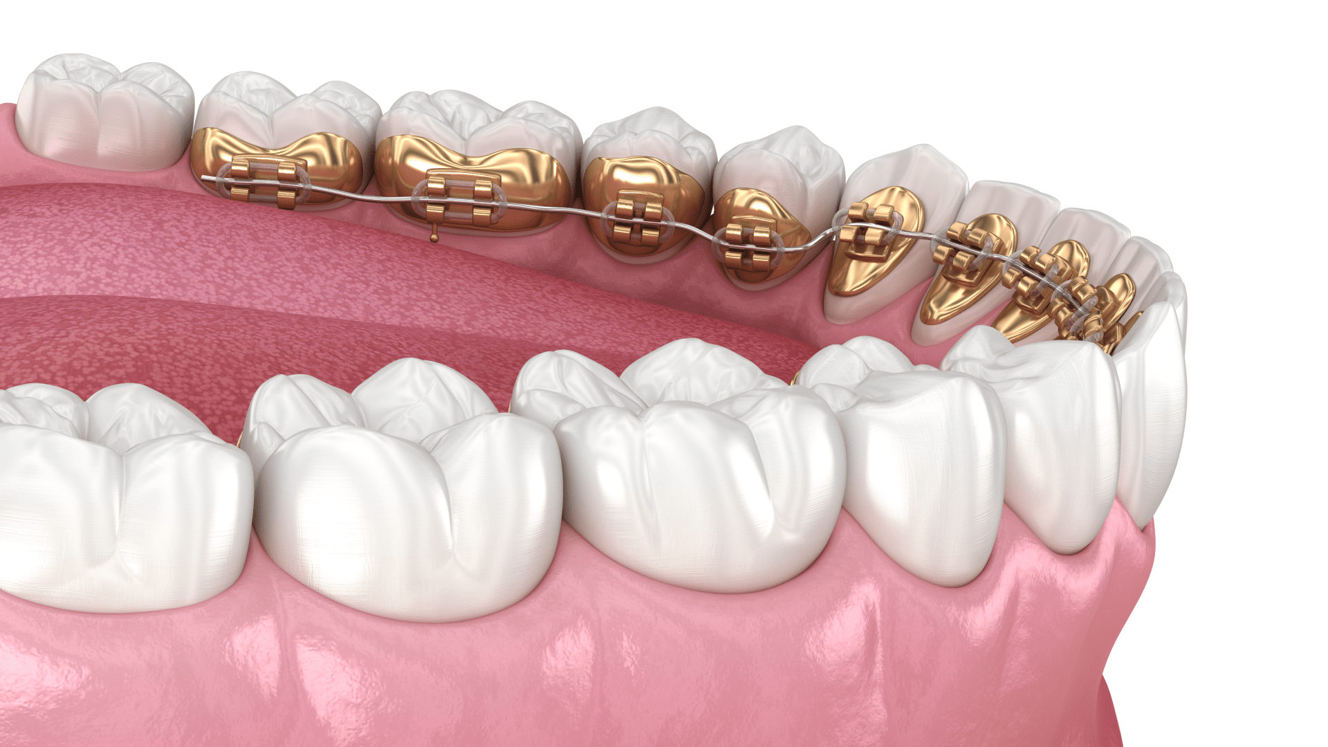 Лінгвальні брекети