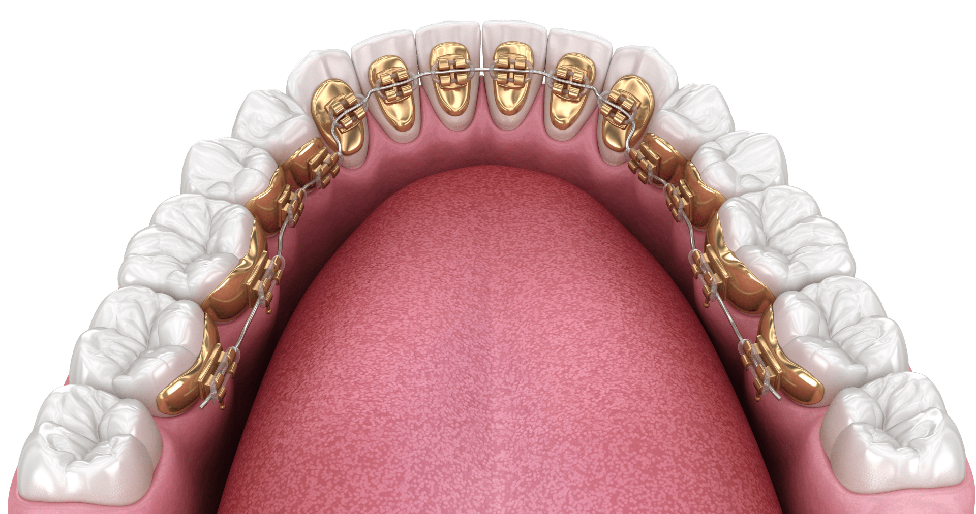 Лінгвальні брекети