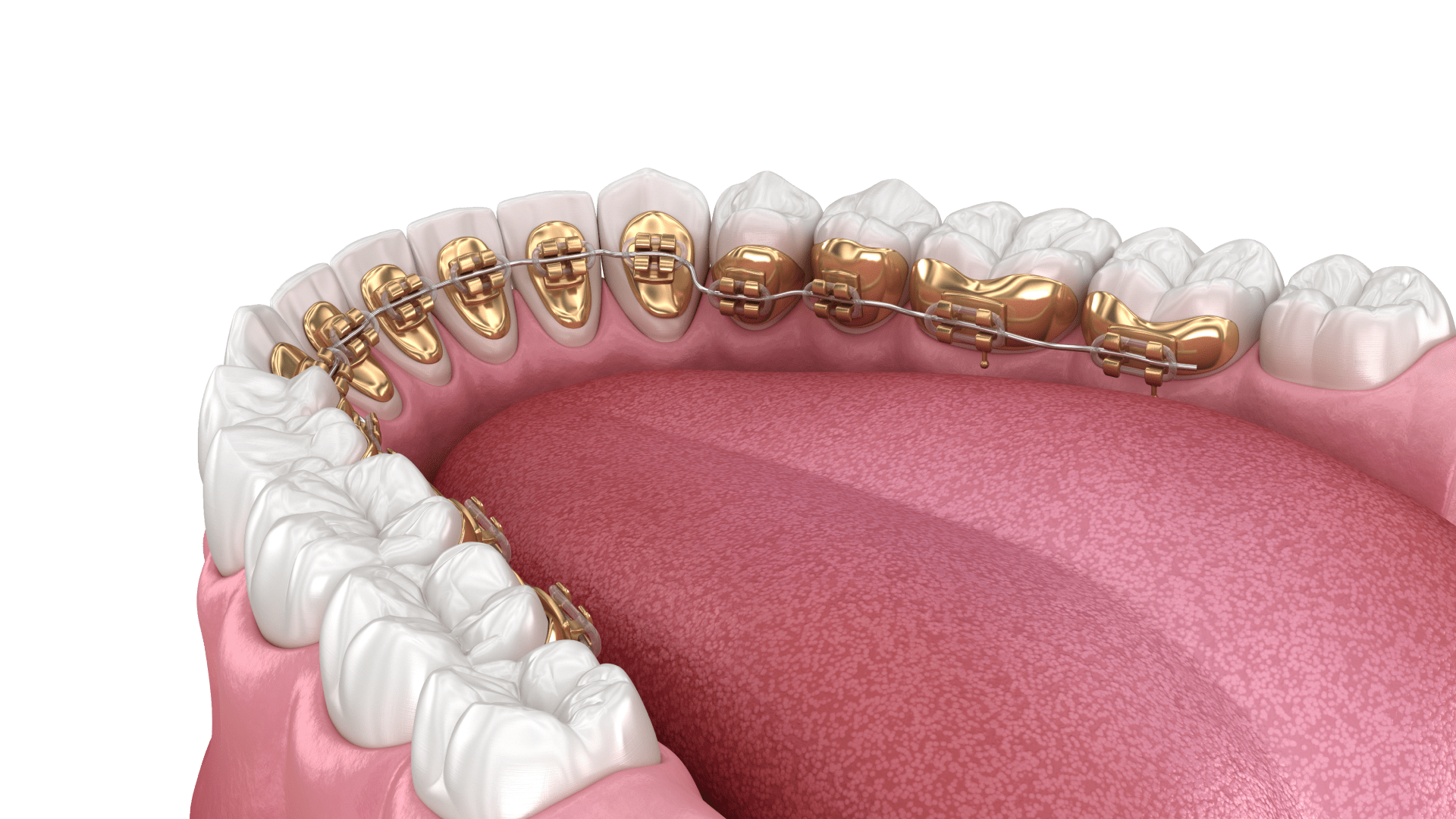 Лінгвальні брекети