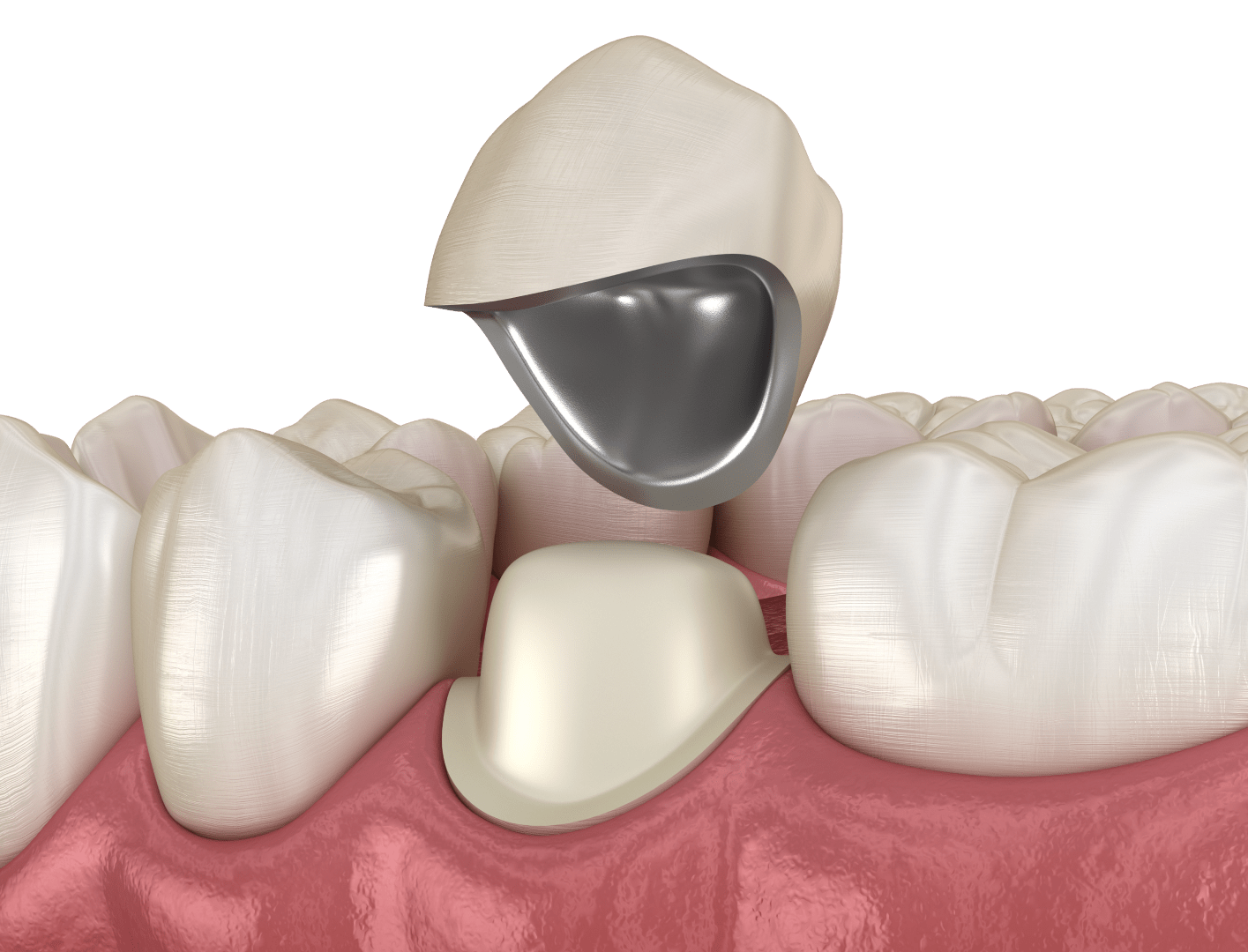 Коронки з металокераміки