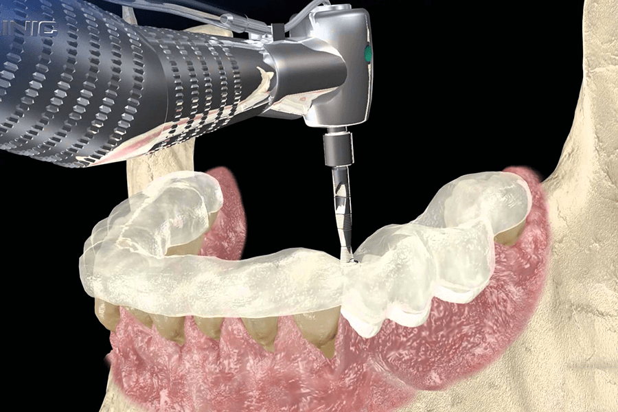 Хірургічний шаблон