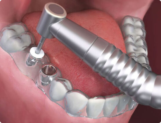 Виготовлення шаблону та встановлення