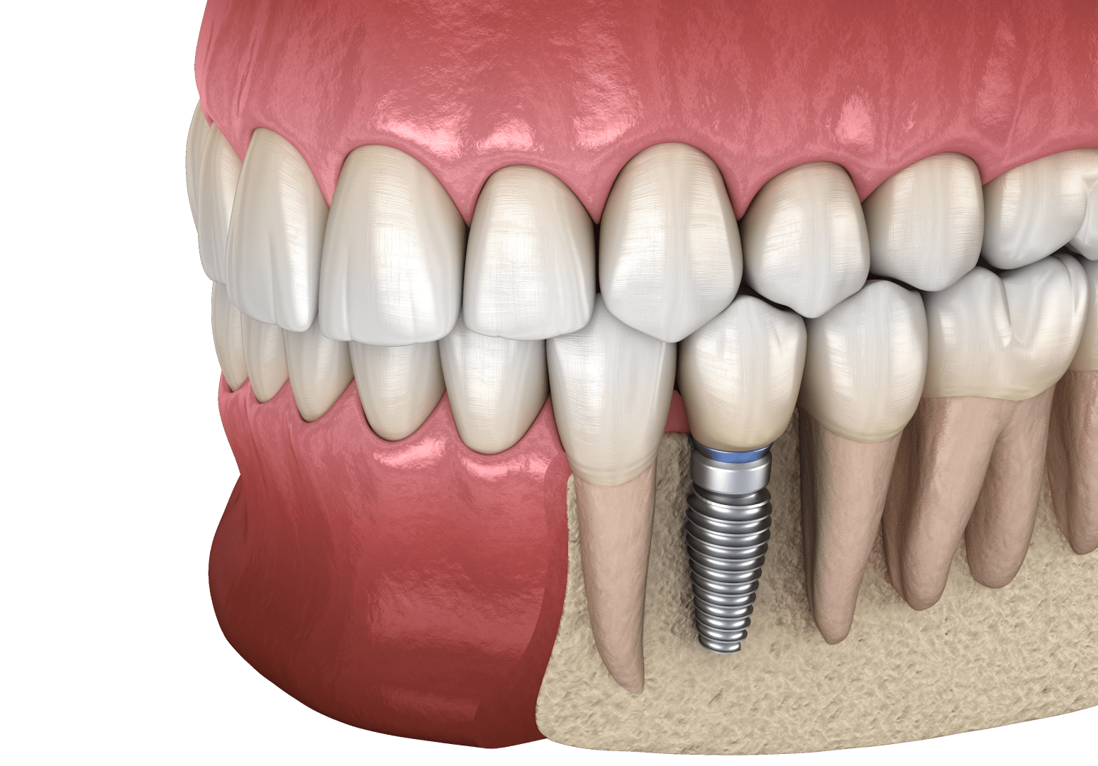 Основні плюси зубного імпланту
