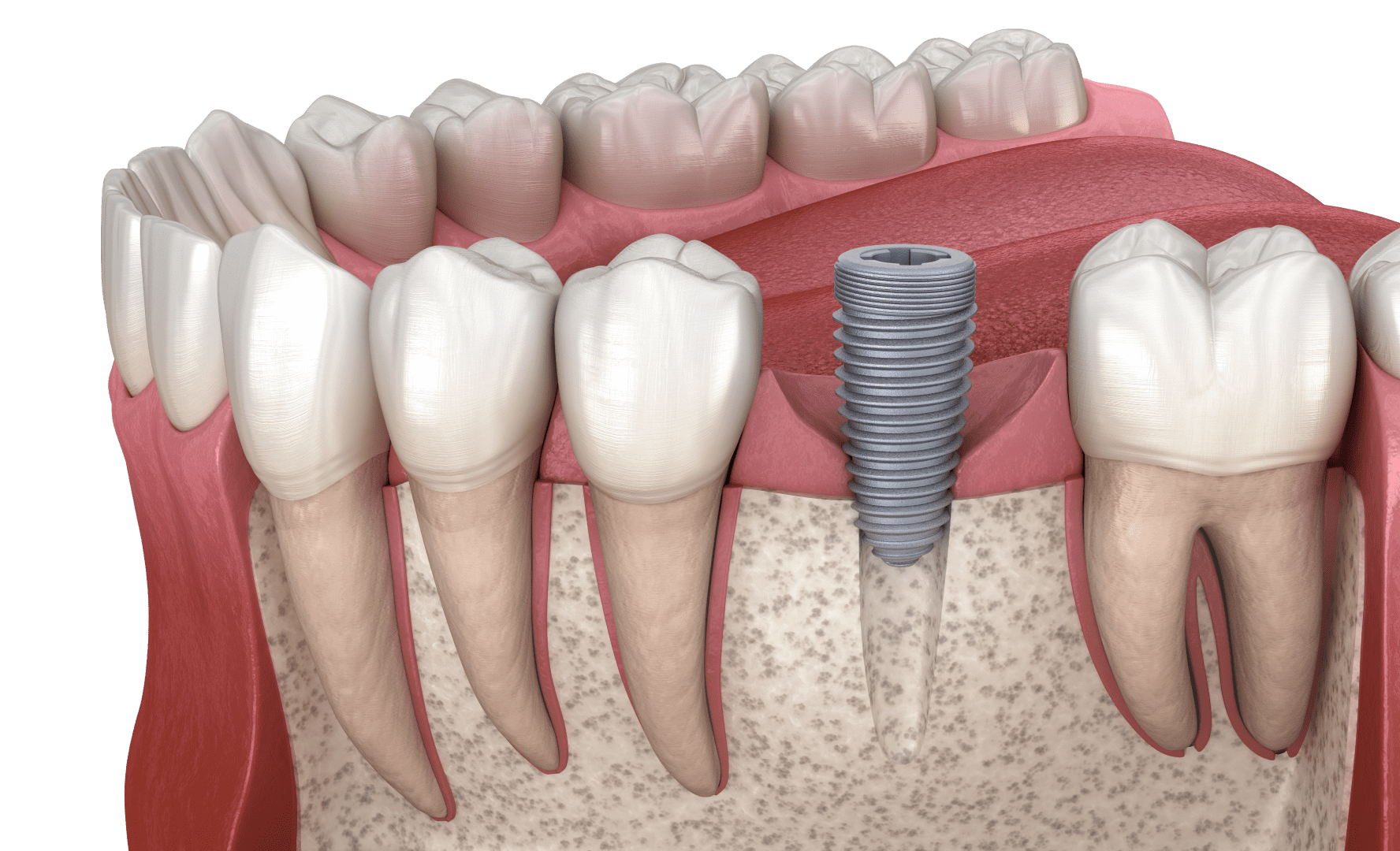 Основні мінуси імплантів