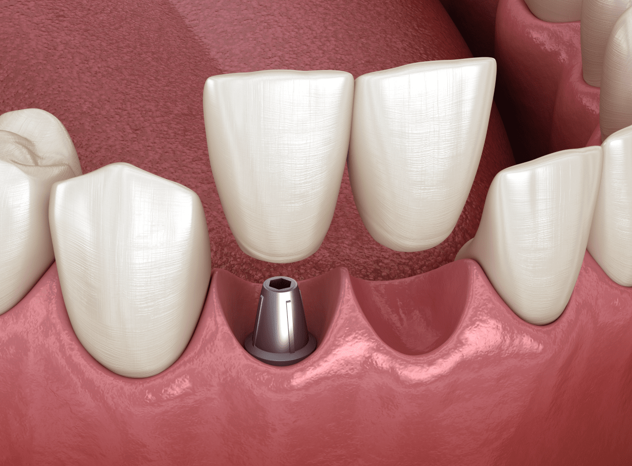 Фіксація тимчасової коронки