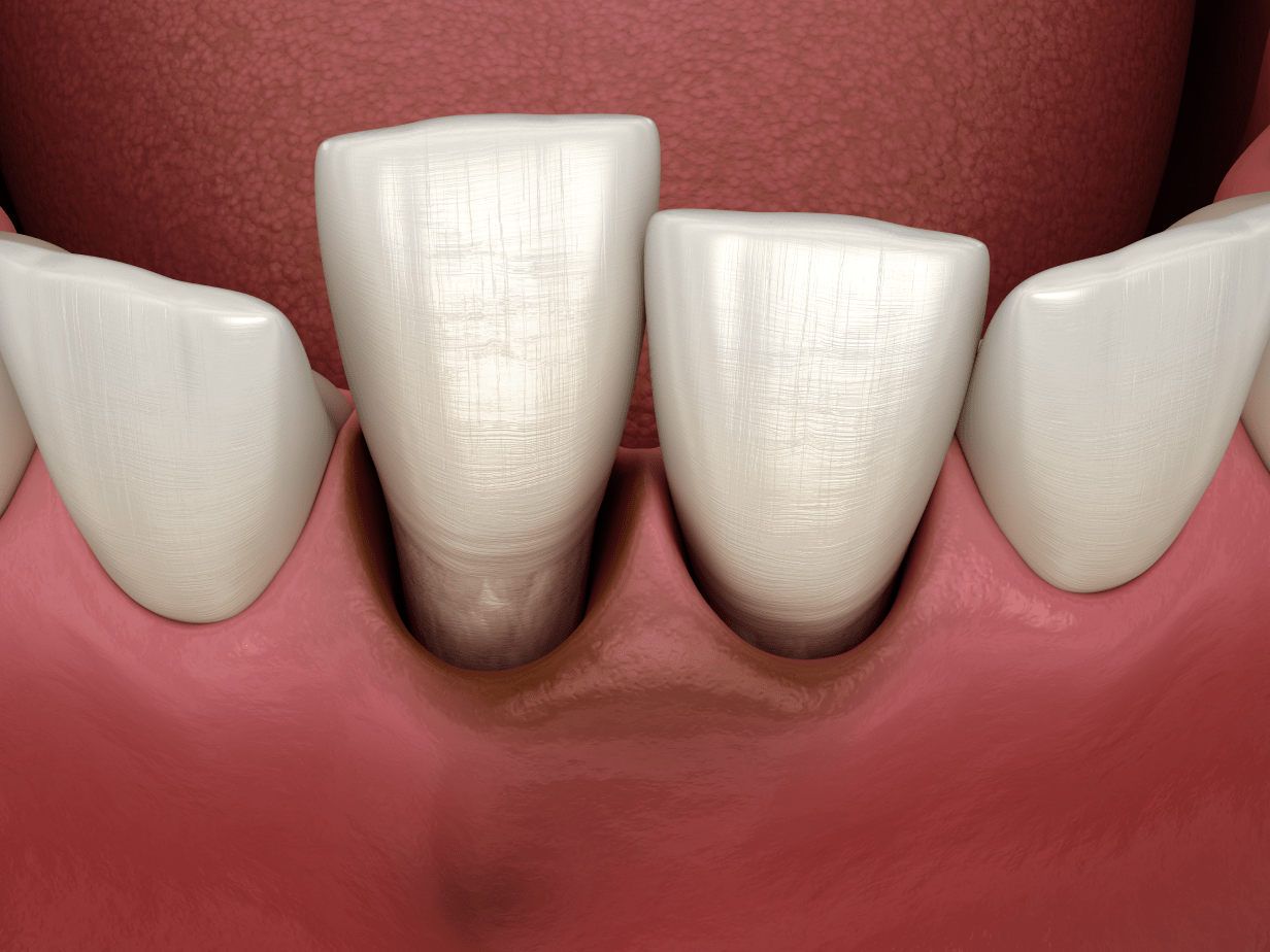 Імплантація передніх зубів