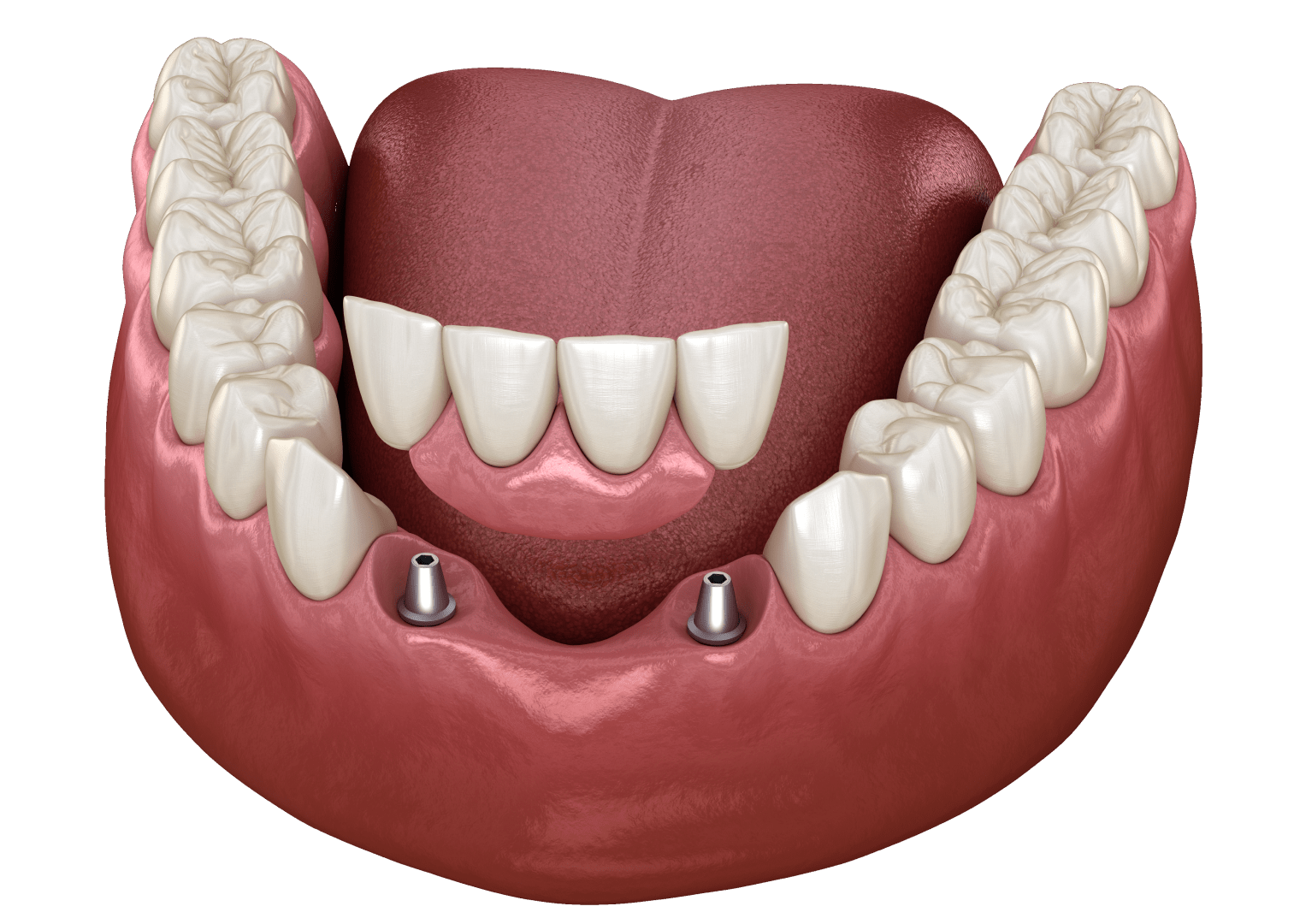Імплантація передніх зубів