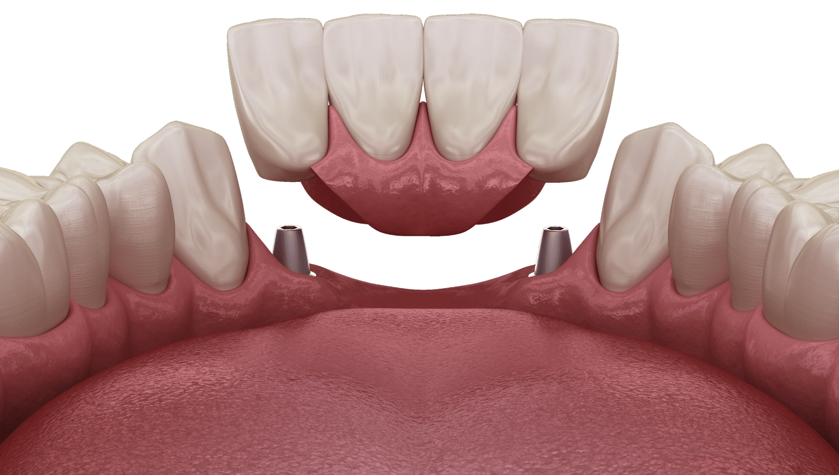 Імплантація передніх зубів