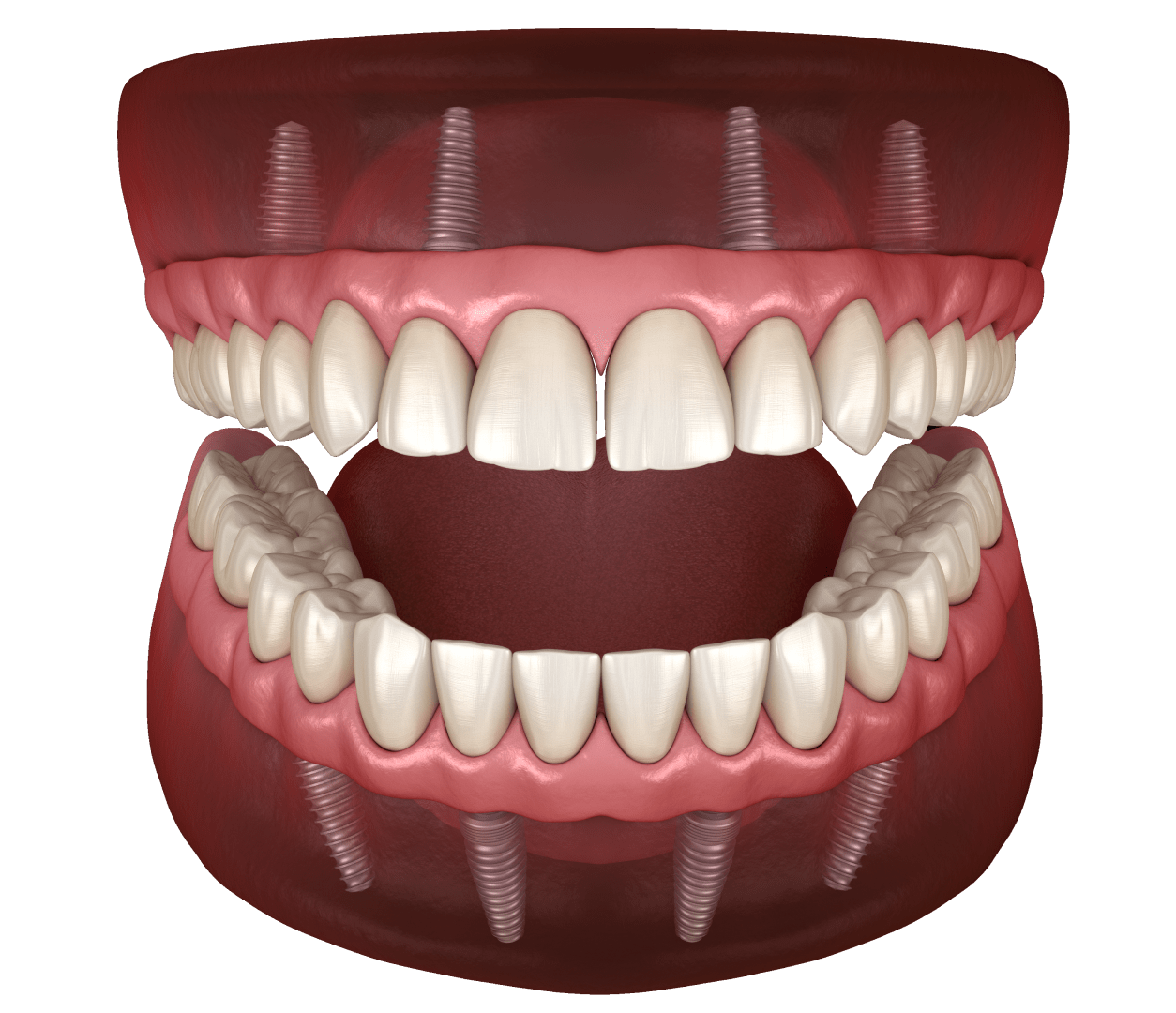 Імплантація за повної відсутності зубів