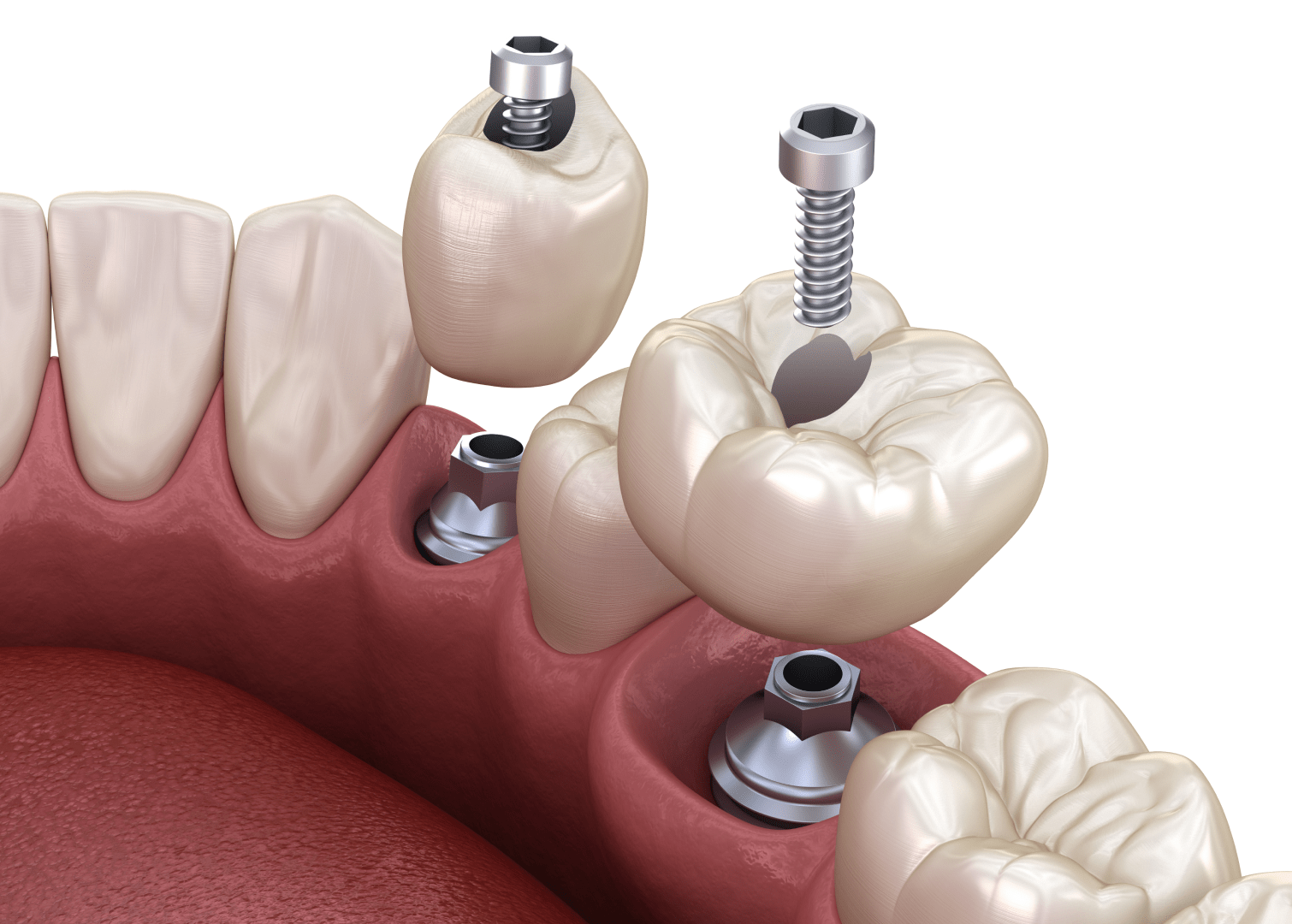 Коронки на імпланти