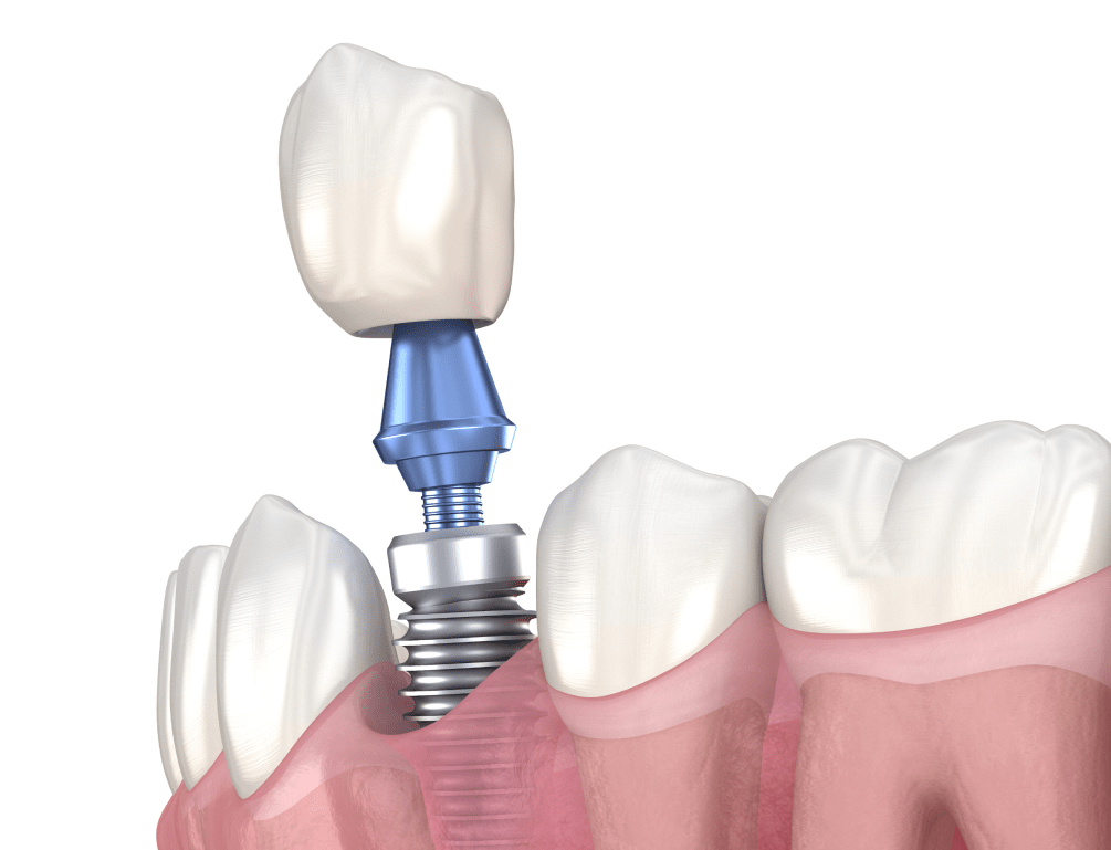 Цирконієві коронки