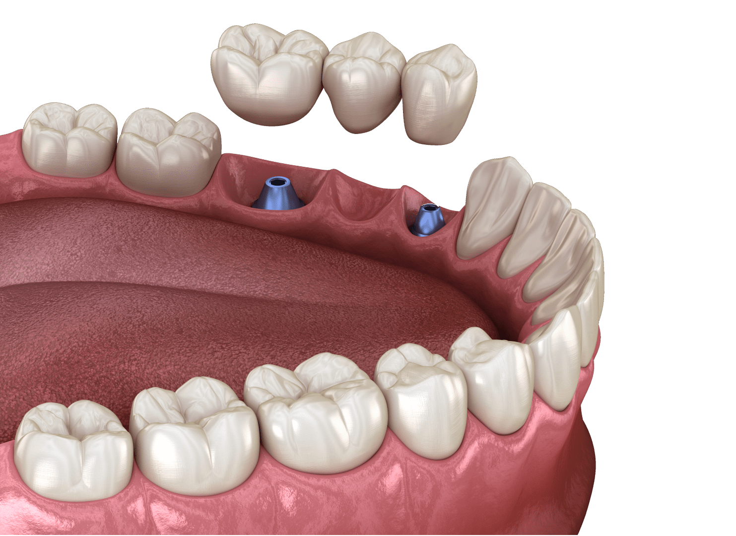Імпланти зубів