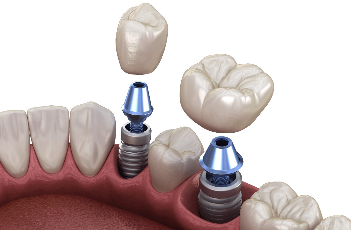 Імпланти зубів