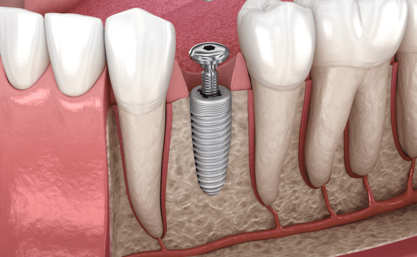 Встановлення зубного імпланту