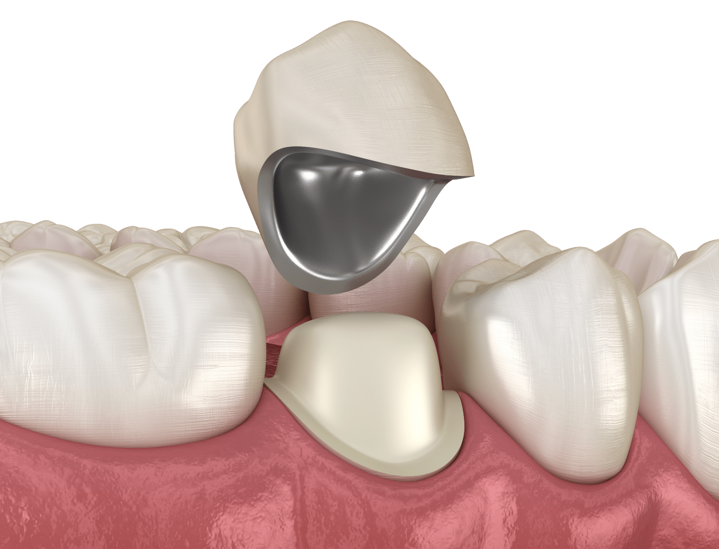 Металокерамічні коронки