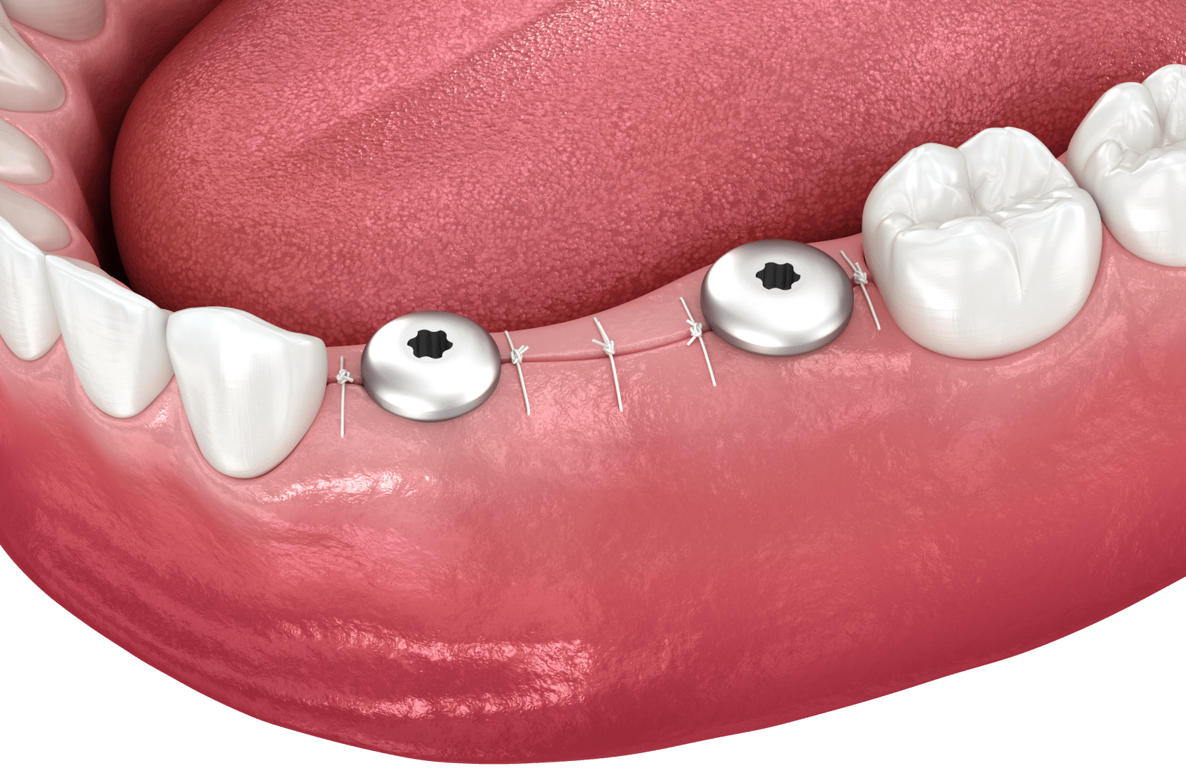 вживлення імпланта