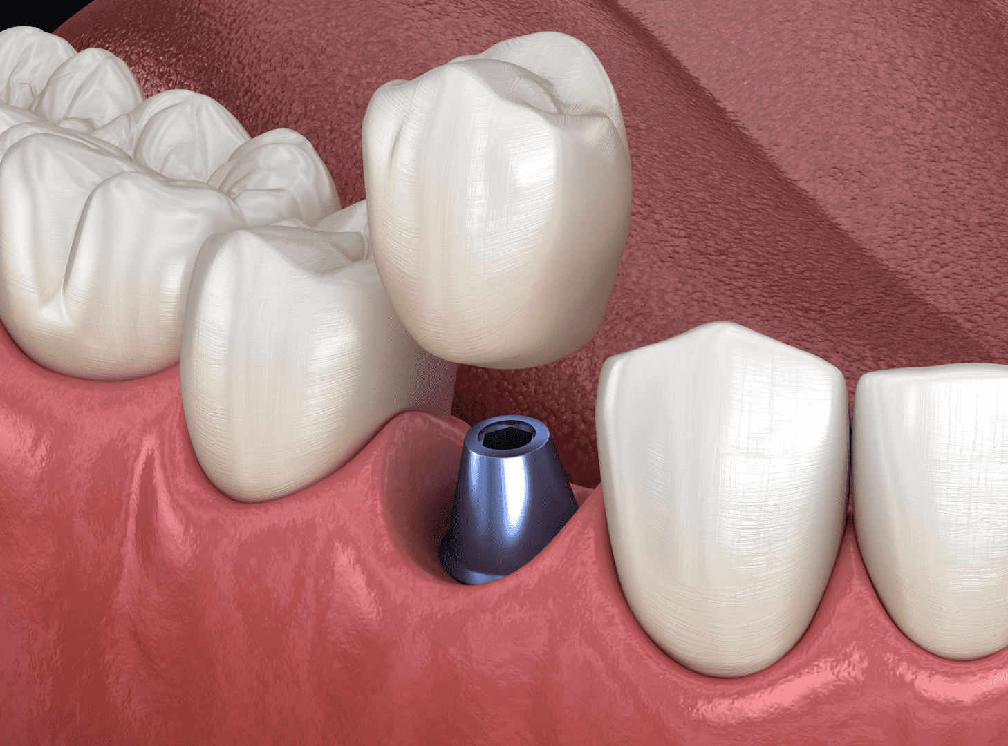 Керамічні коронки