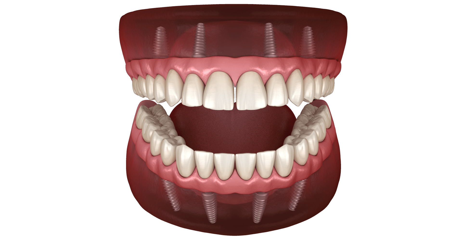 Протезування