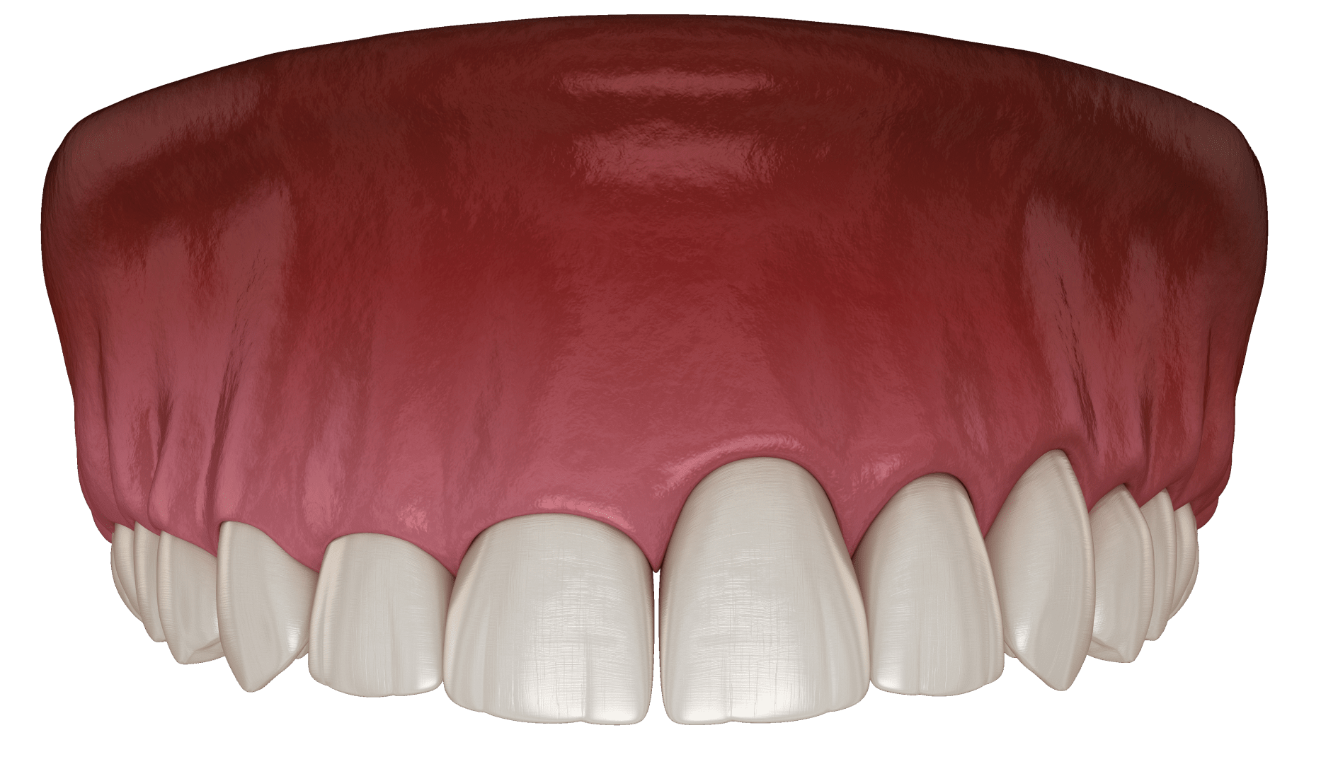 Гінгівопластика ясен