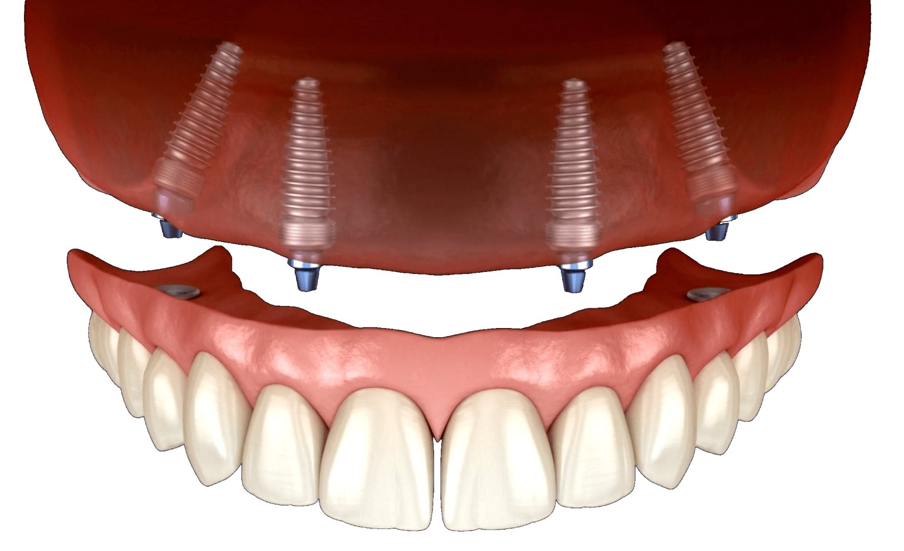 Імплантація