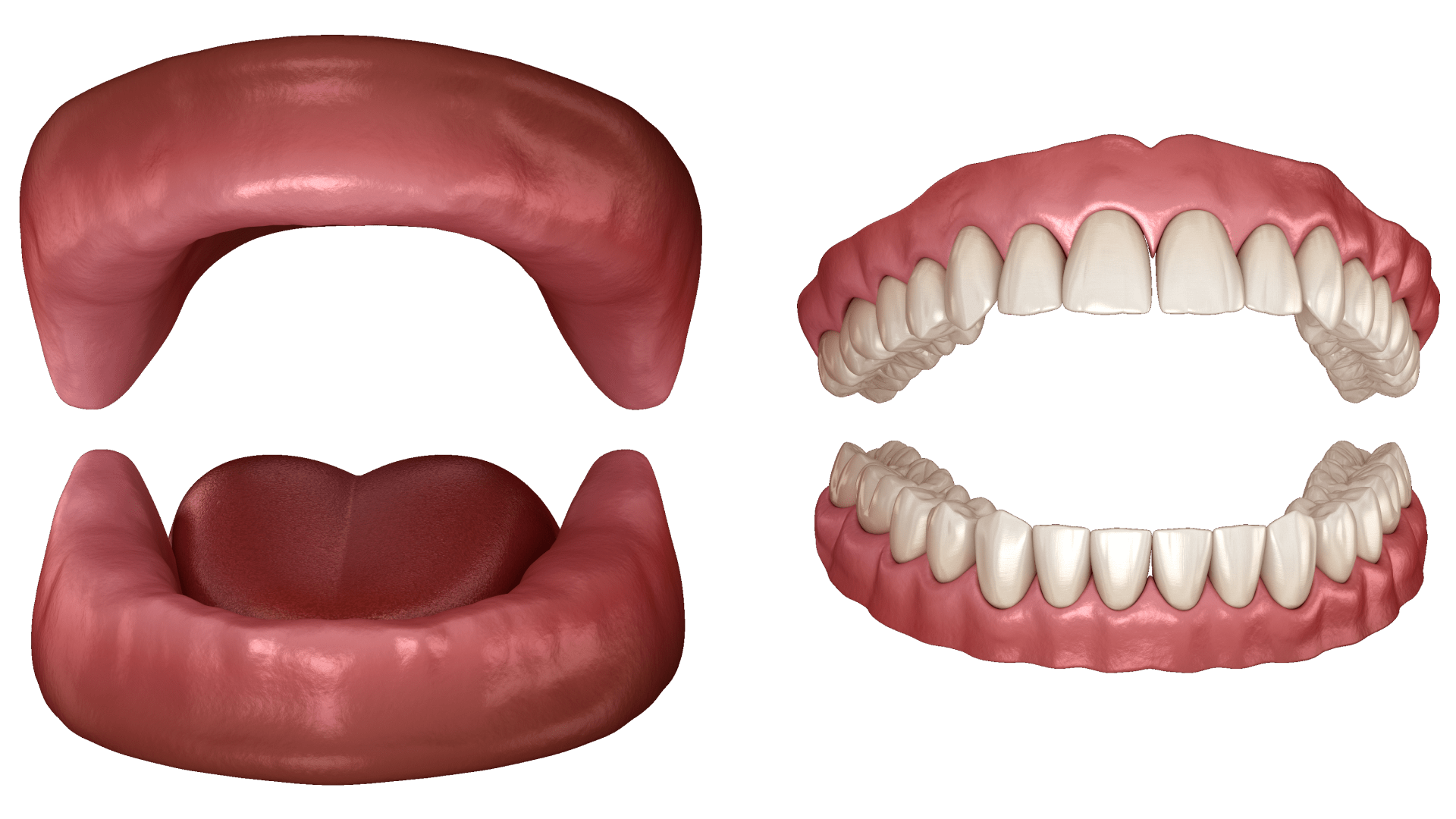 Імплантація за повної відсутності зубів