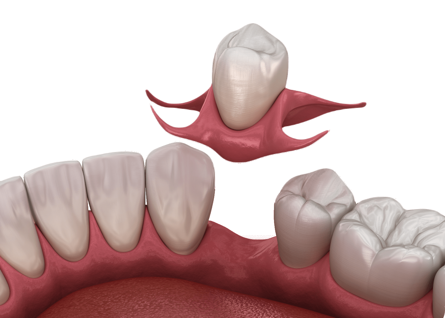 Знімні протези
