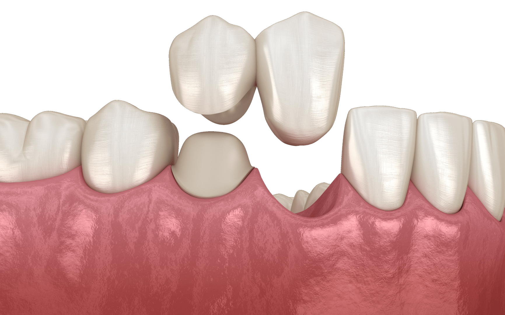 Протезування передніх зубів