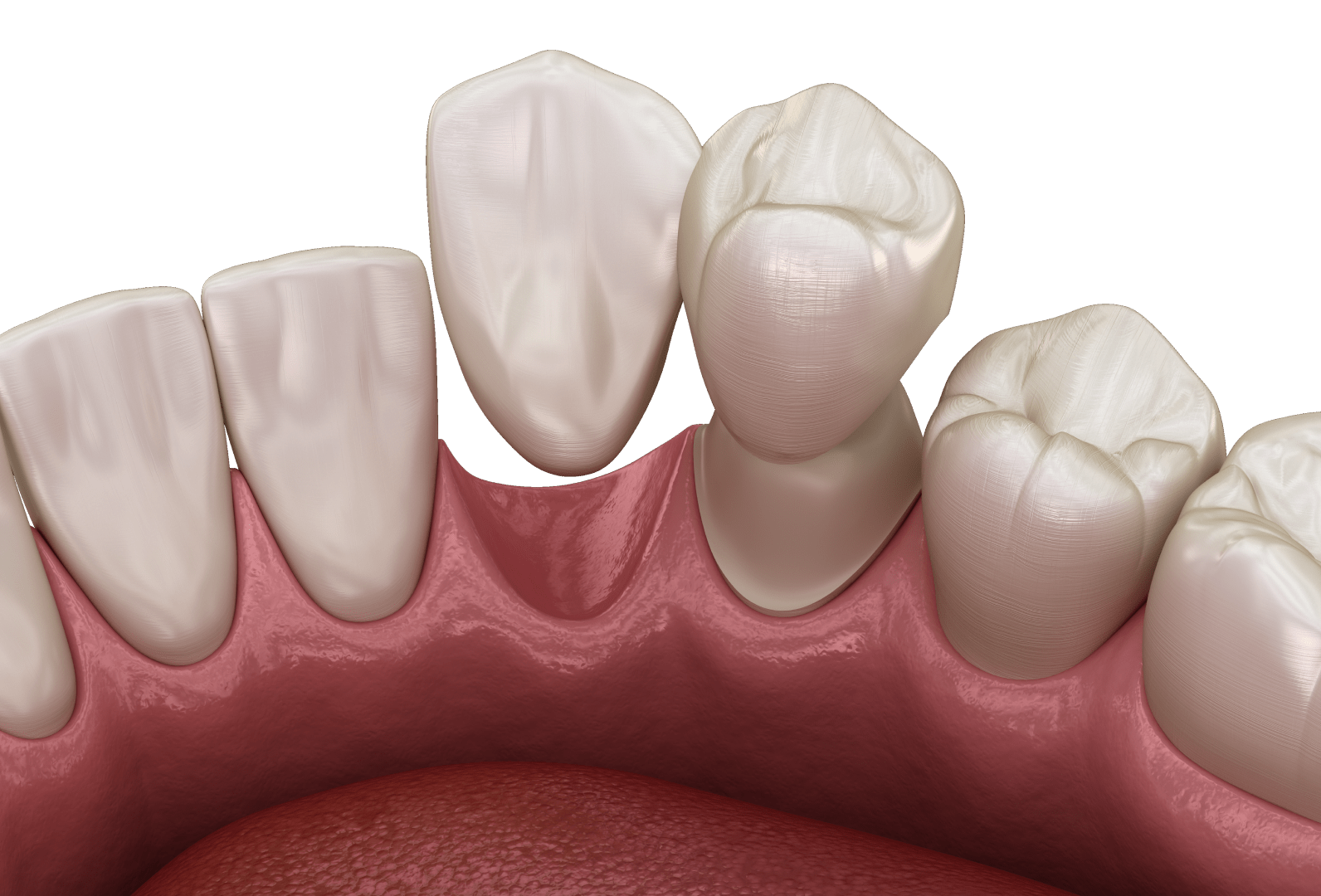 Коронки на передні зуби