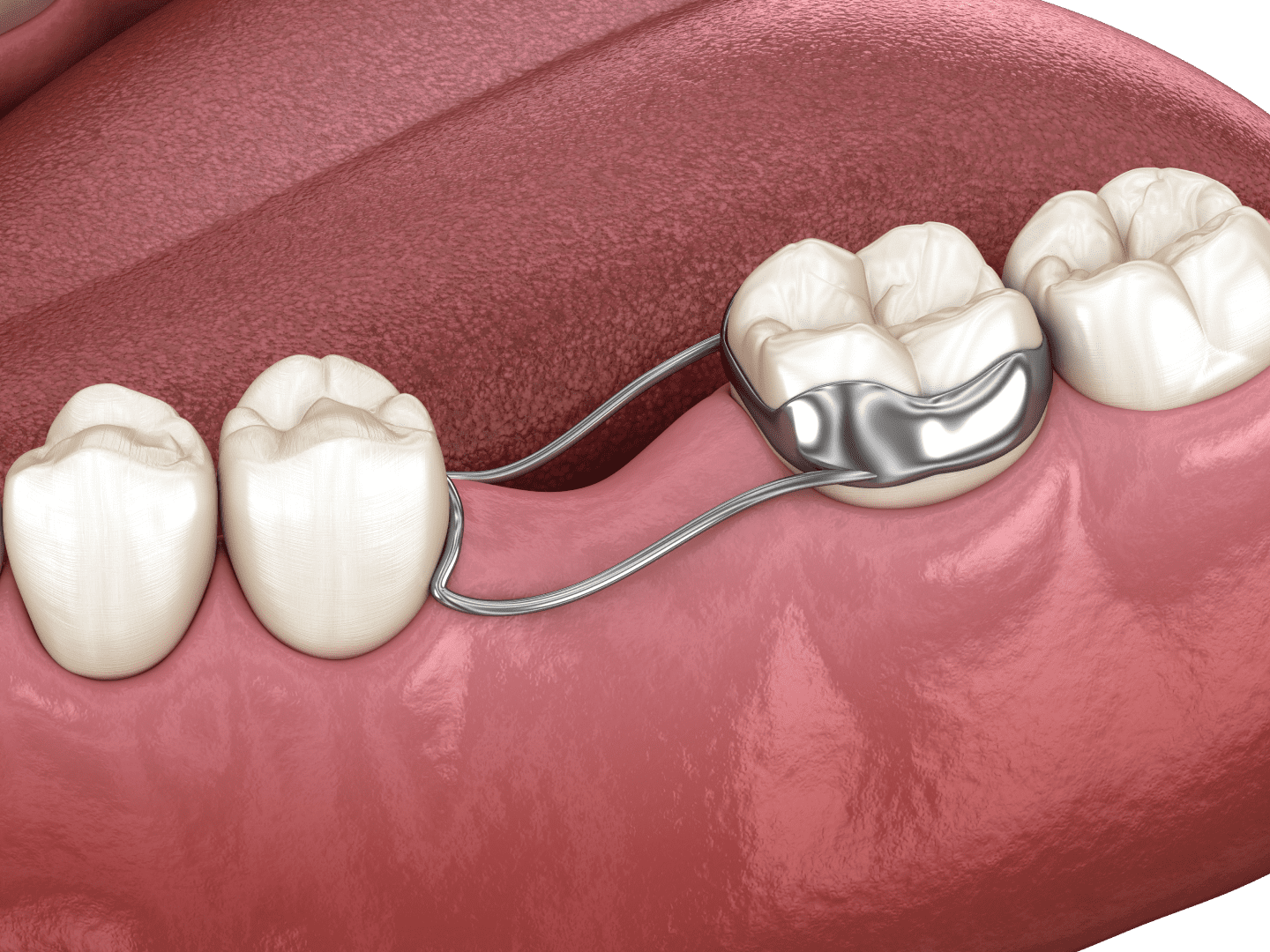 Імплантація, якщо зуб видалений давно