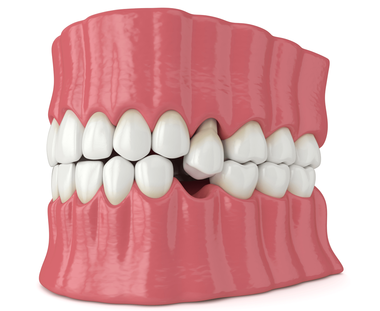 Імплантація, якщо зуб видалений давно