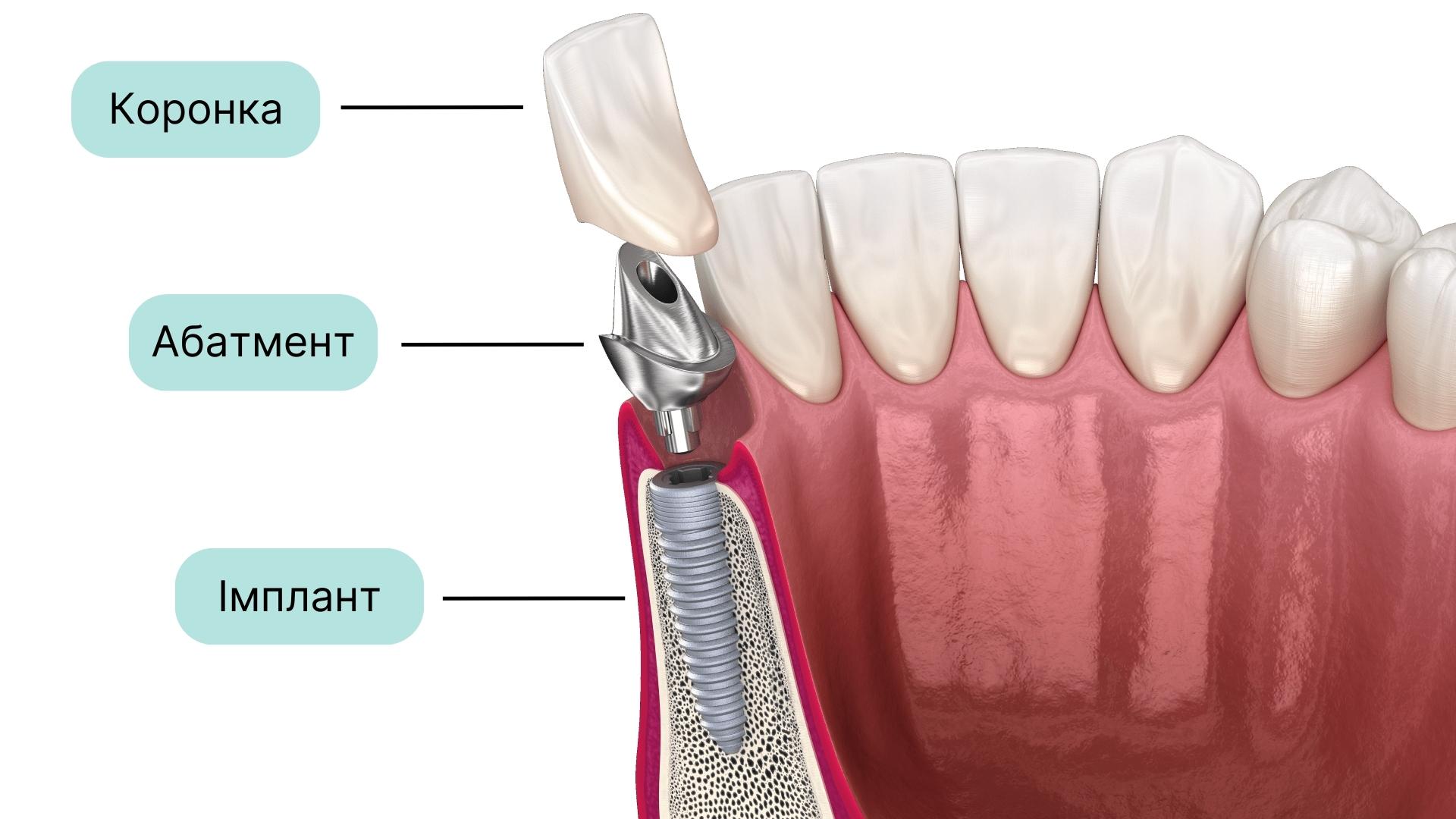 Встановлення абатменту