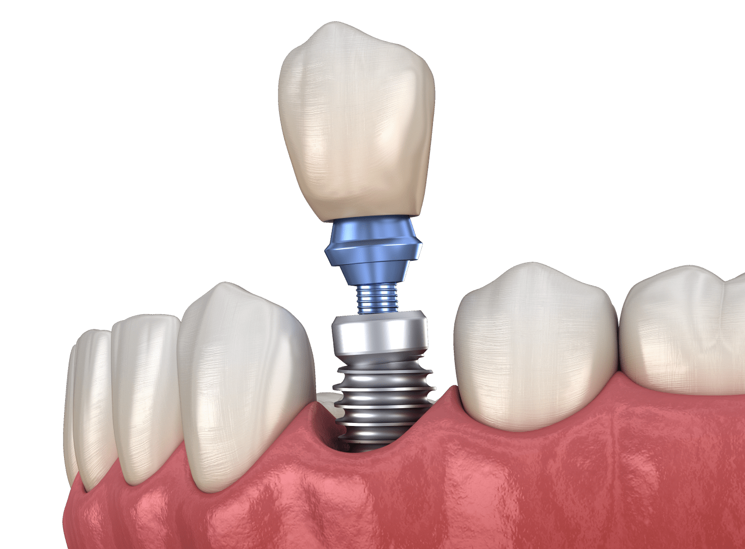 Встановлення абатменту