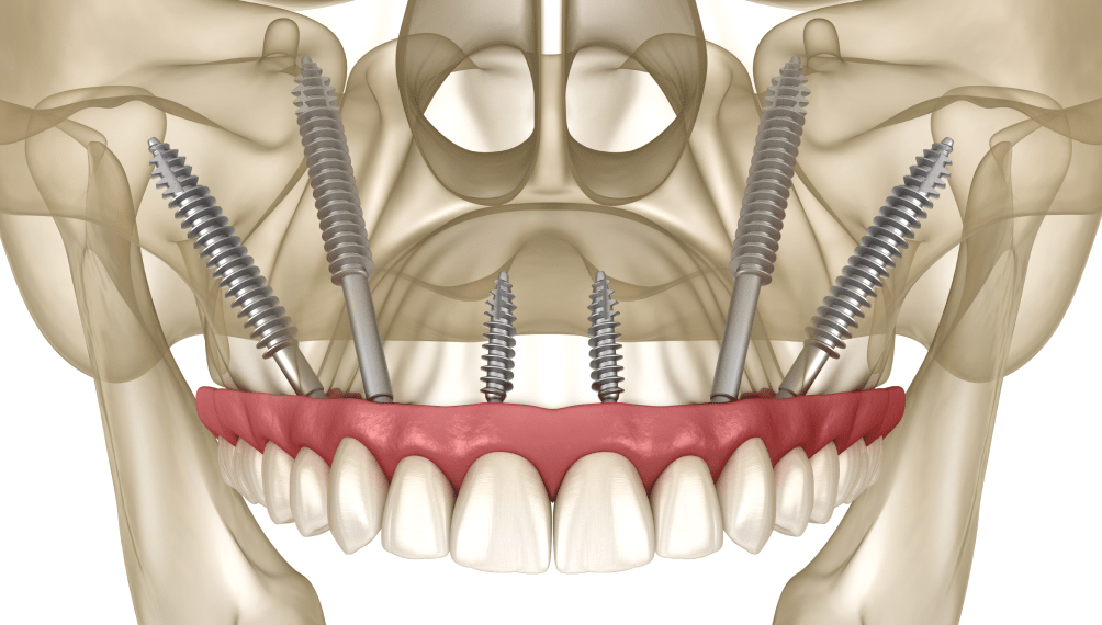 Базальна імплантація