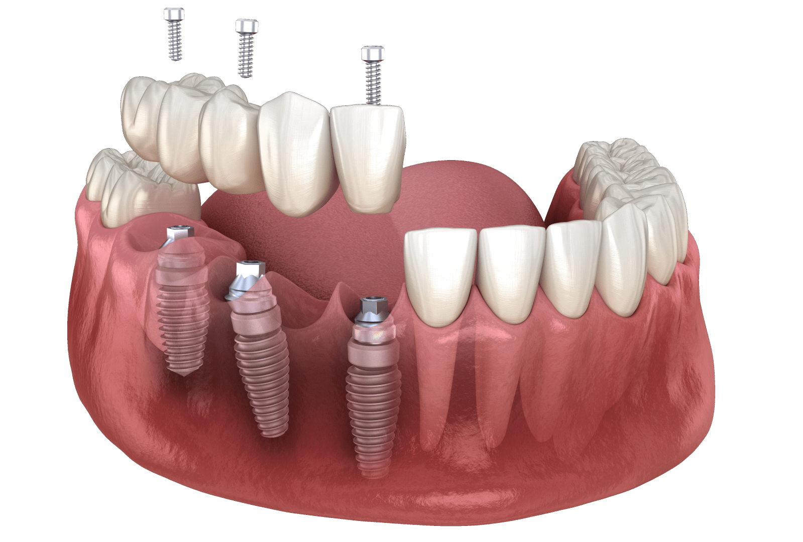 Чи боляче ставити імплант зуба