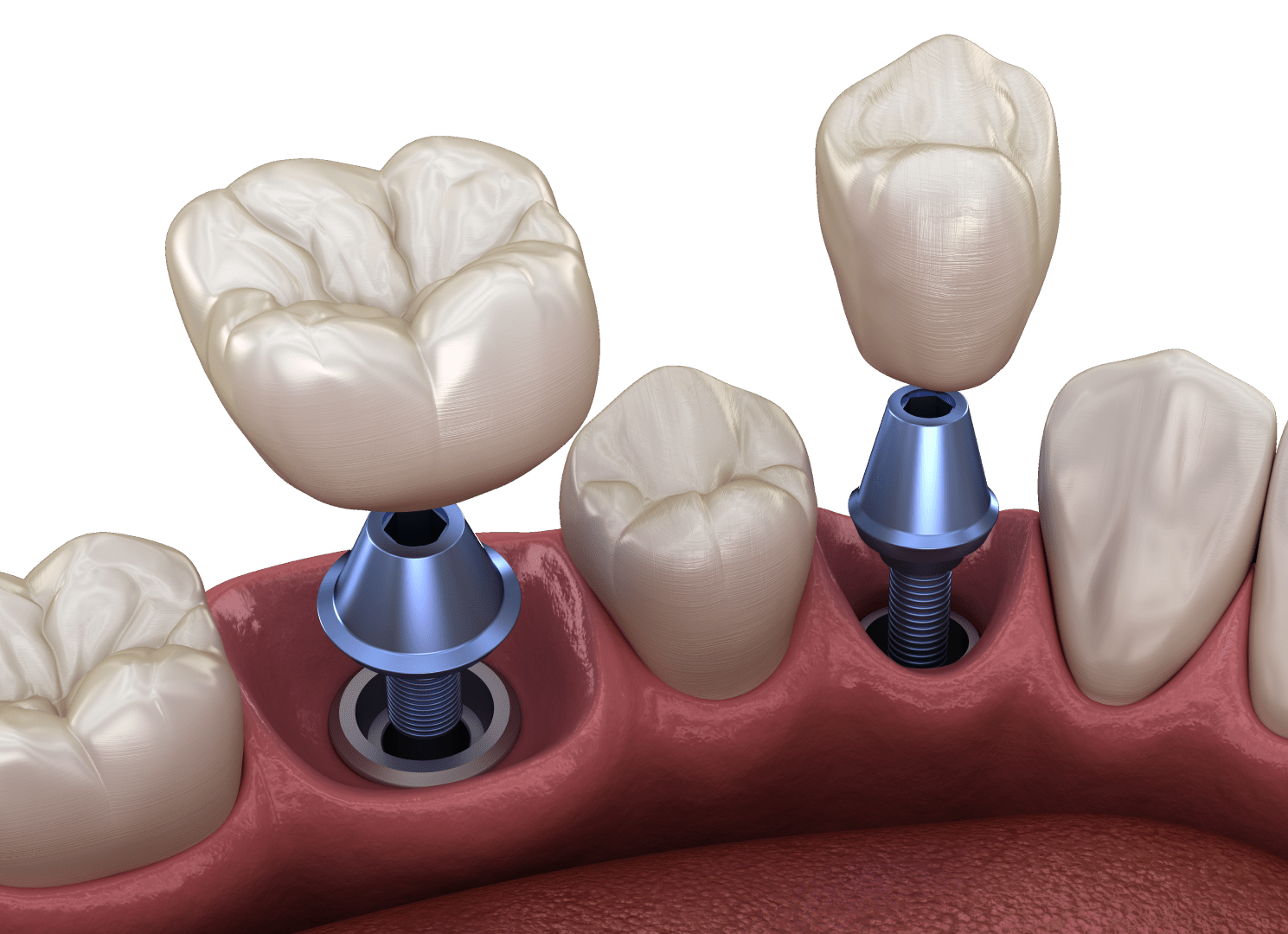Імплантація зубів