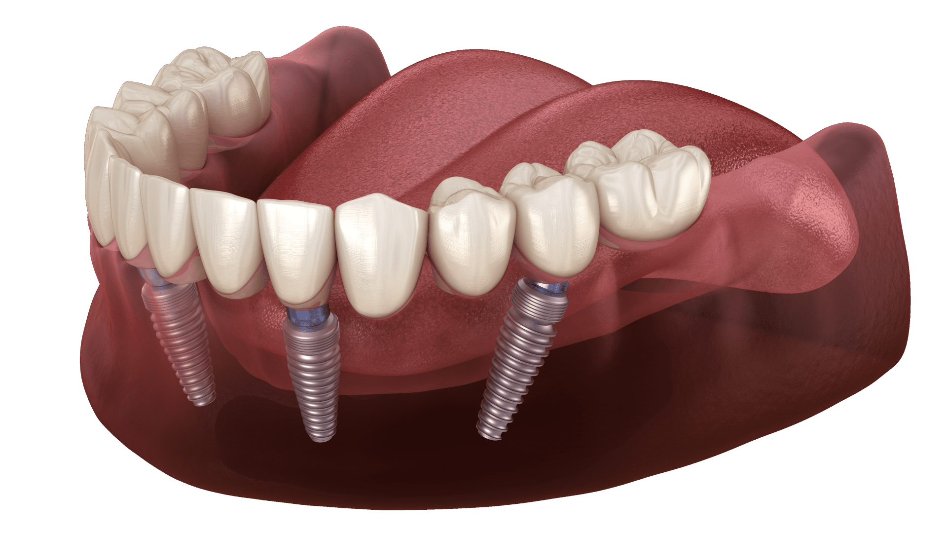 Імплантаця зубів