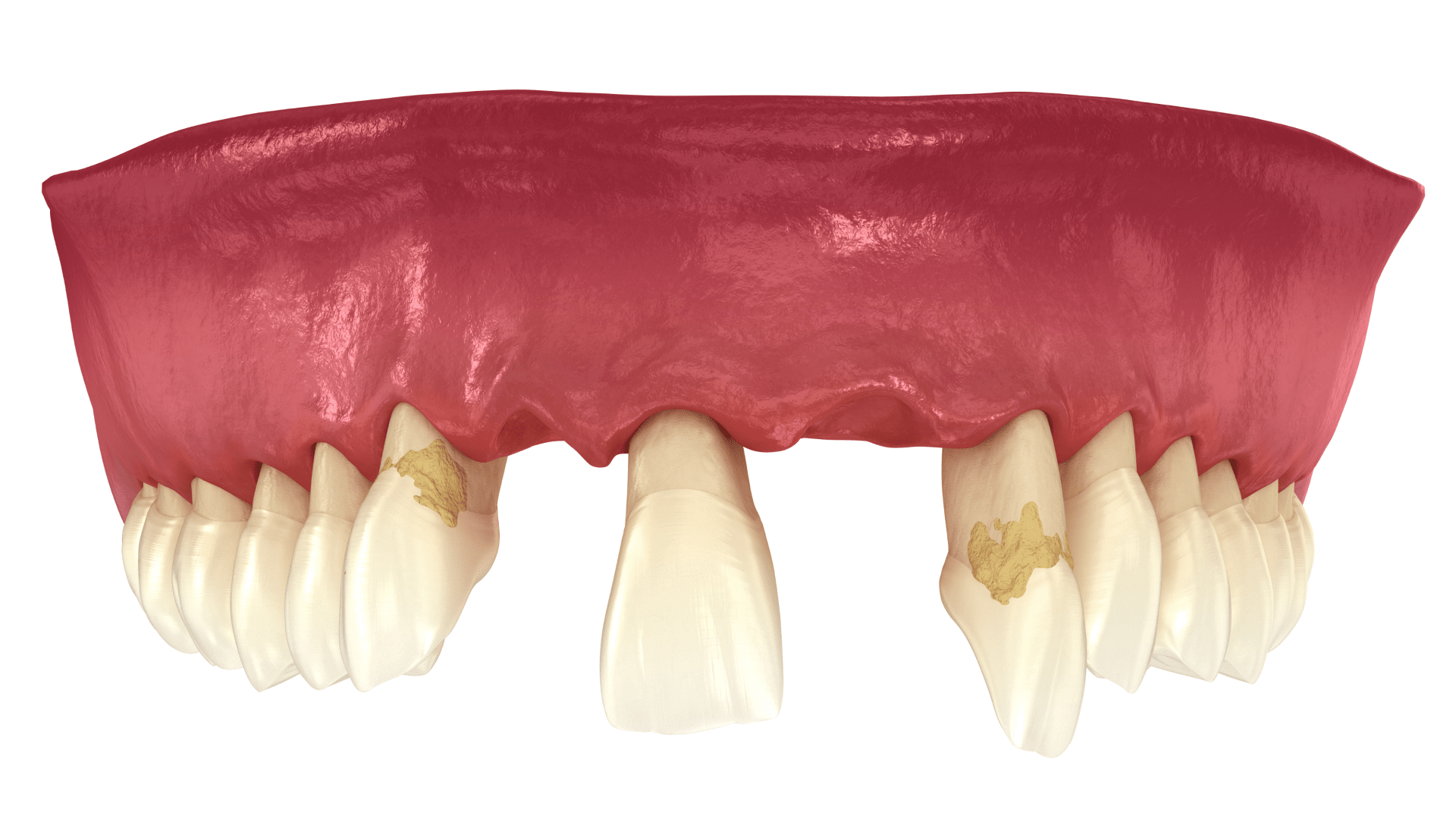 Гнилі зуби – чи потрібно видаляти?