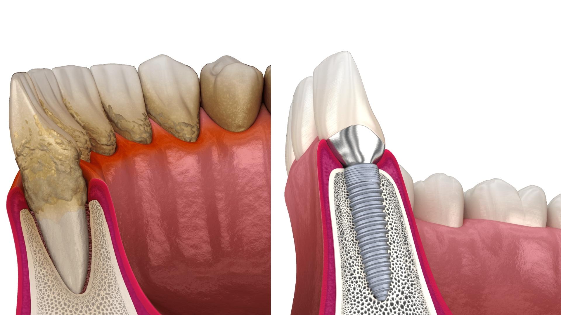 Имплантация при заболеваниях